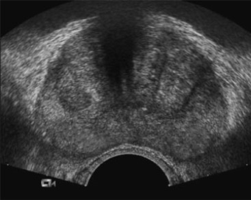 Prostate Ultrasound