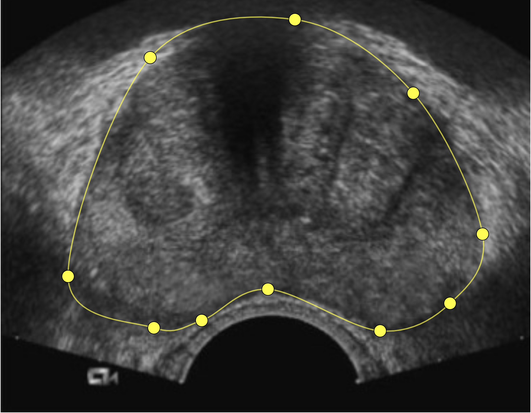 Outlined Prostate